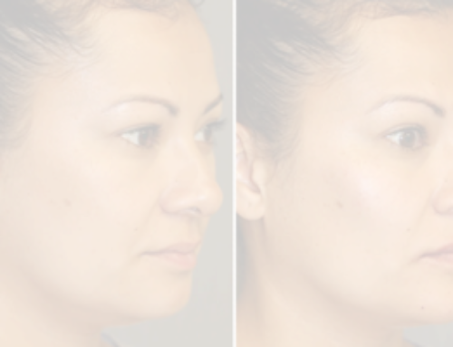 FILLERS AND WRINKLE RELAXERS