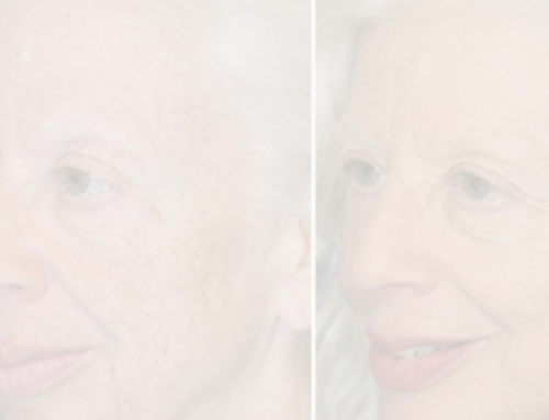 FACIAL REJUVENATION