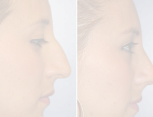 RHINOPLASTY & SEPTORHINOPLASTY