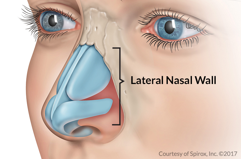 Latera Implants for Nasal Obstruction in Culver City