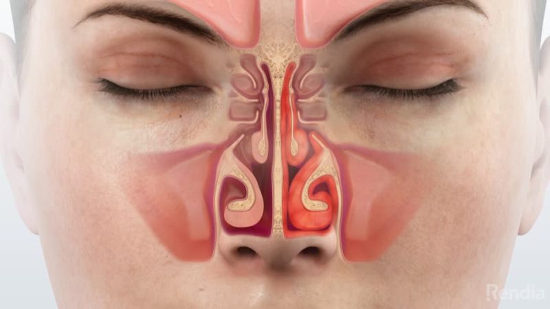 what-causes-turbinates-to-swell-westside-sinus