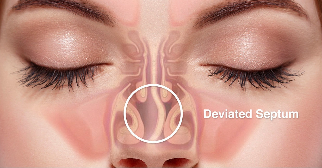 Septoplasty Aftercare