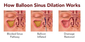 What It&#8217;s Like Getting A Balloon Sinuplasty Procedure