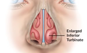 Enlarged Turbinates: Care Instructions