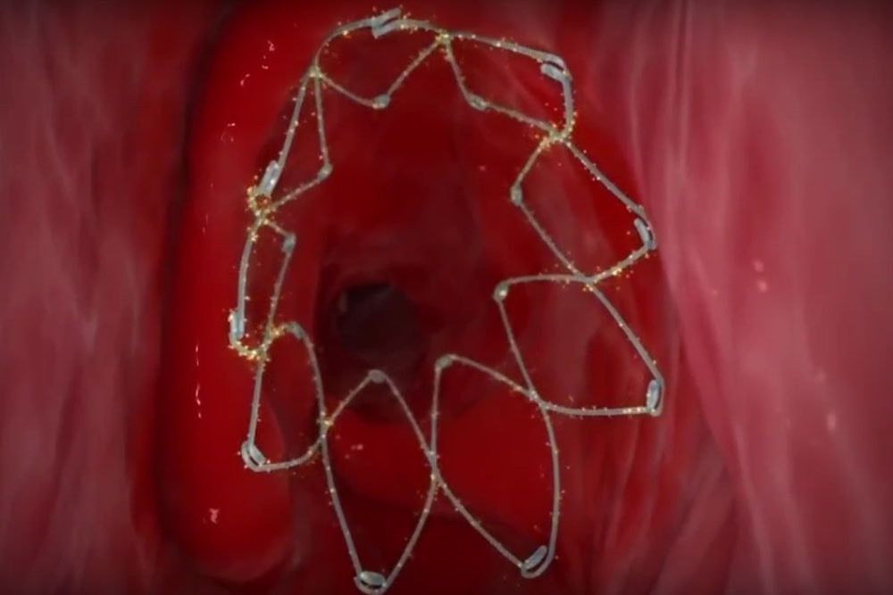 How Long Do Sinus Stents Stay in After Sinus Surgery?